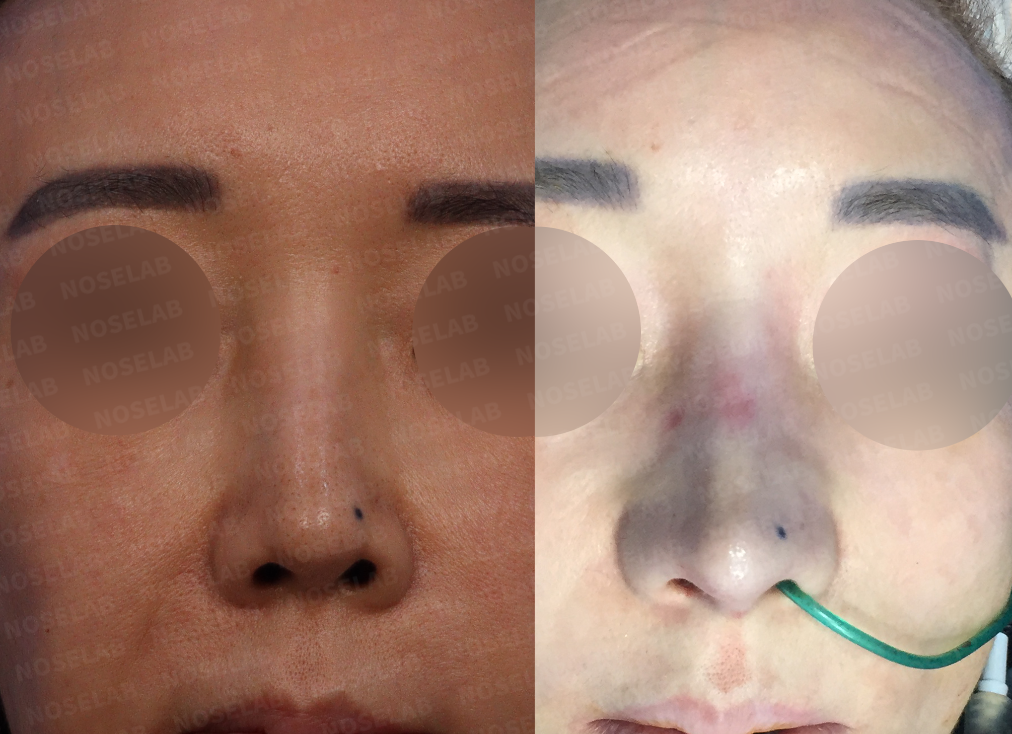 Frontal comparison photographs illustrating improved nasal symmetry and midline alignment after comprehensive revision procedure