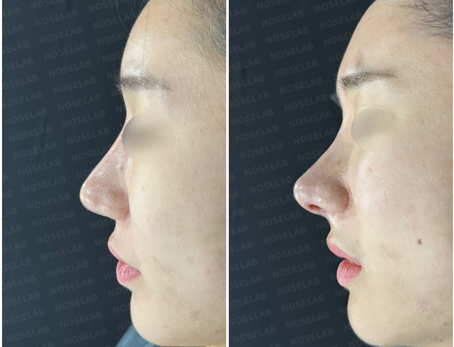 Before and immediately after side profile view of nostril reconstruction following excessive nostril reduction with rib cartilage graft and closed rhinoplasty