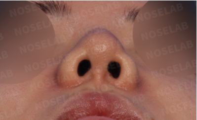 Preoperative nostril view showing asymmetry and small nostrils before bulbous nose and retracted columella correction