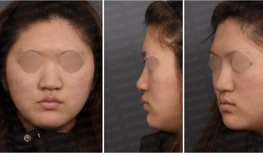 Preoperative design consultation photos showing bulbous and wide nasal tip, weak tip definition, and overall blunt nasal contour from frontal, left oblique, and left lateral views.