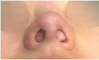 Immediately after secondary rhinoplasty: Nostril base view showing correction of asymmetry and improved nostril shape.