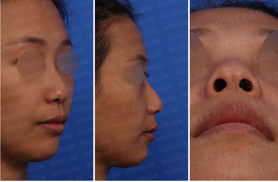 Pre-surgery design consultation photos for split nasal tip correction: right side view, oblique side view, and nostril view.