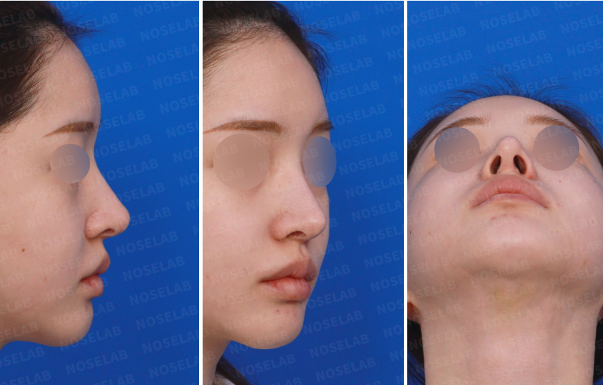 Preoperative design consultation photos for closed rhinoplasty Korea, showing right side view, right oblique view, and nostril (base) view to assess nasal tip projection, nostril exposure, septal alignment, and overall nasal structure before surgery.