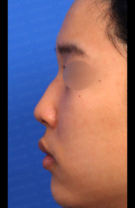 sed rhinoplasty Korea before and after side view video – short and hump nose correction using self rib cartilage, improved nasal line and tip projection