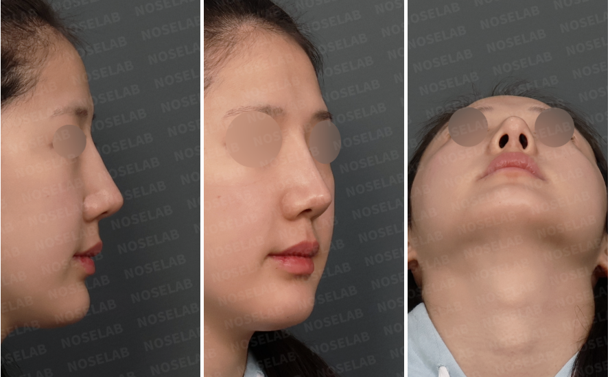 Preoperative consultation photos showing right side profile, right oblique view, and nostril view of a patient with crooked nasal bones and a dorsal hump before revision closed rhinoplasty.