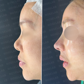 Side profile views showing feminine nasal tip refinement and nasal bridge correction after secondary rhinoplasty.