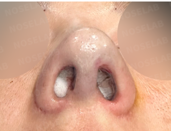 Immediate postoperative nostril view showing nostril symmetry and columella alignment after revision rhinoplasty using rib cartilage graft.