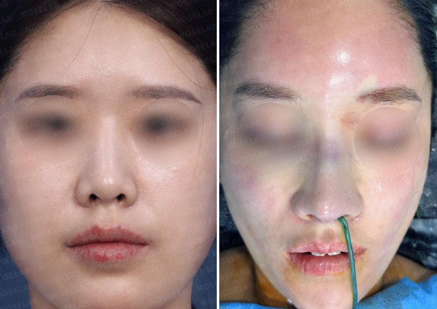 Protruding mouth rhinoplasty – before and after frontal view comparison photos (left: before surgery, right: after surgery)