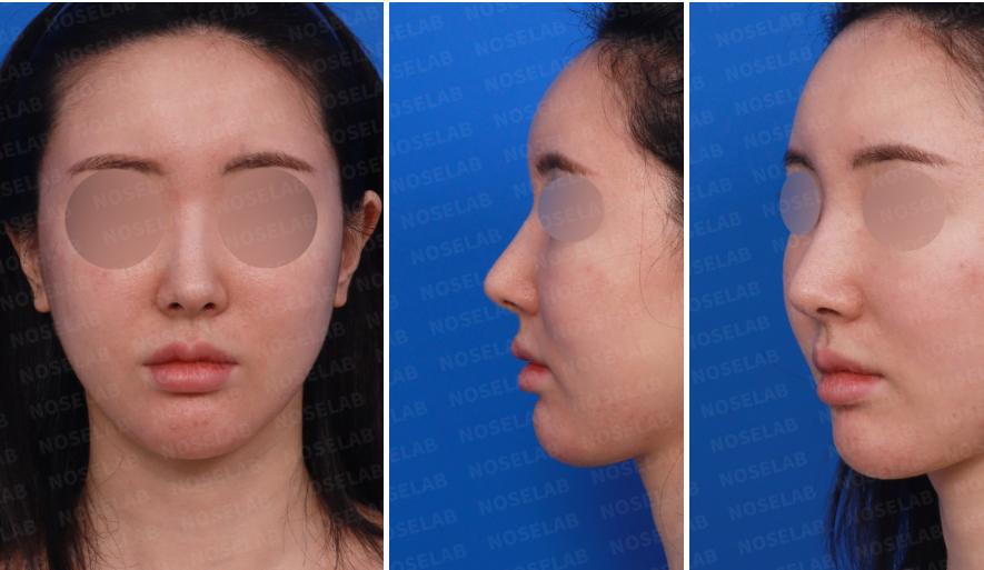 Preoperative design consultation photos before Feminine Rhinoplasty: frontal view, left oblique side view, and left side view showing long nose and nostril asymmetry.