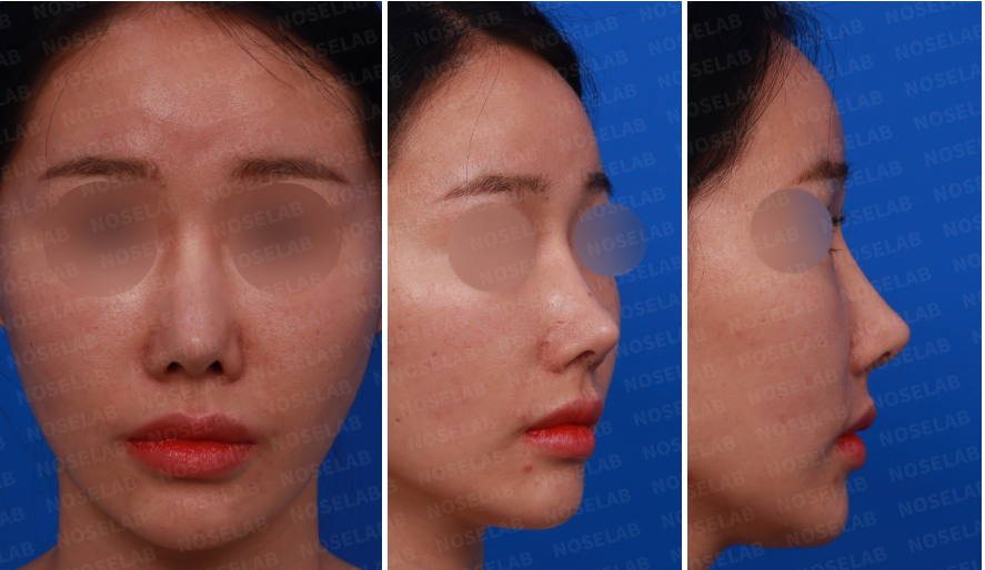Pre-surgery design consultation photos: frontal view, left side view, and left oblique side view