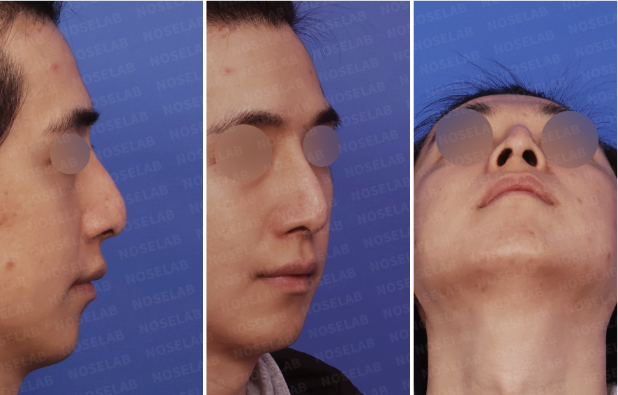 Preoperative design consultation images showing right lateral view, right oblique side view, and nostril view of a male patient with septal collapse and nasal tip drooping.