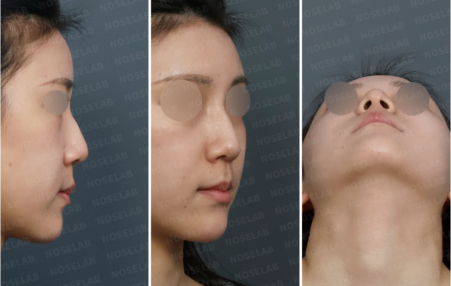 Preoperative consultation images showing right lateral view, right oblique view, and nostril view of a patient with a drooping nasal tip and dorsal hump after previous nasal filler and thread lifting procedures.