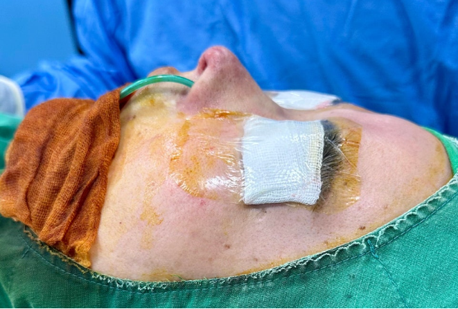 Short nose and columellar depression correction – intraoperative photo after septal reconstruction and alar cartilage suturing during revision rhinoplasty