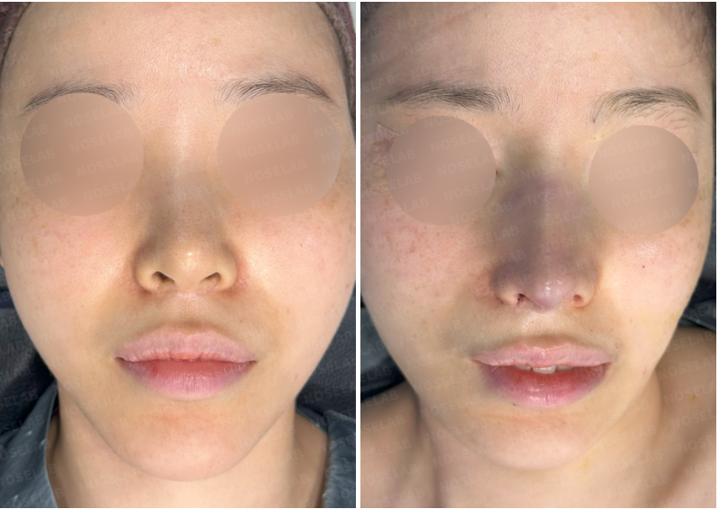 Frontal photos showing the nose before surgery (left) and immediately after surgery (right).