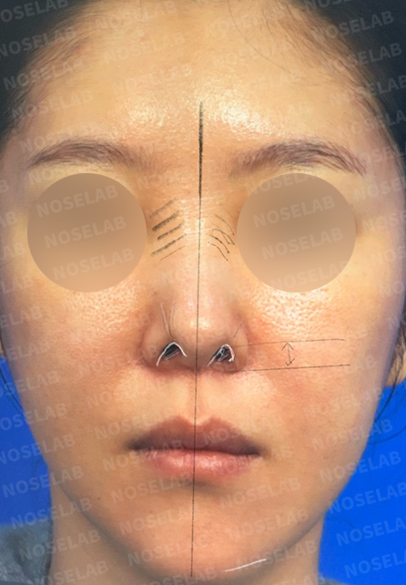 Frontal view documentation demonstrating nasal axis deviation and tip asymmetry requiring correction at Korean rhinoplasty clinic