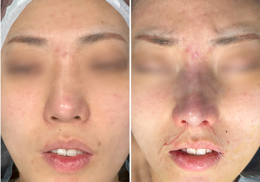 Before (left) and immediately after surgery (right) – front view of the patient's nose