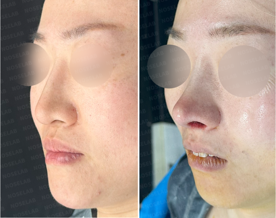Oblique side view comparison of the patient before (left) and immediately after (right) revision rhinoplasty showing reduction of nasal length, improved tip definition, and dorsal line correction.