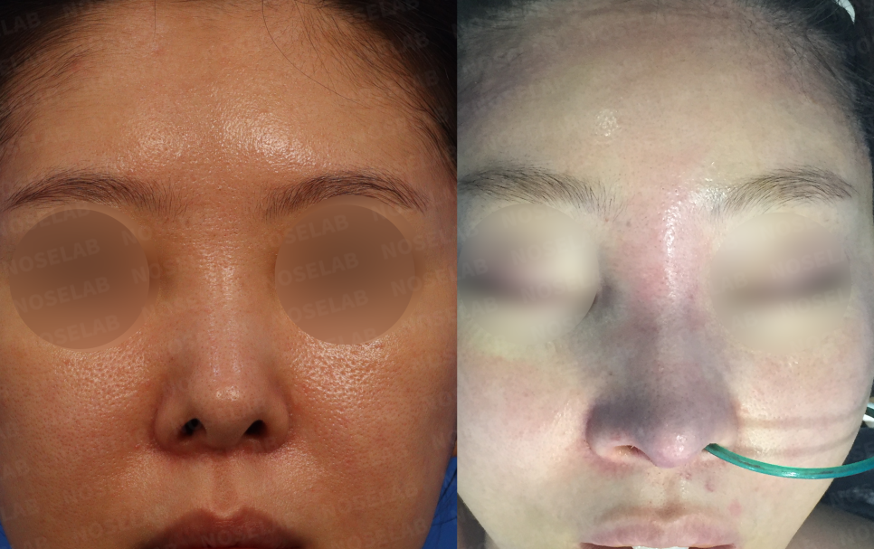 Frontal comparison photographs showing correction of nasal deviation and improved nostril symmetry after reconstructive procedure