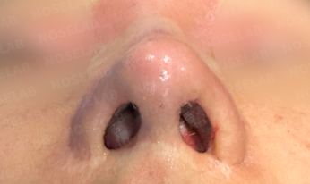 Rhinoplasty for long mid-face correction – immediate postoperative nostril view photo