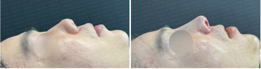 Male revision rhinoplasty before and after side profile comparison – showing lowered upturned tip, corrected columella, and improved nasolabial angle.