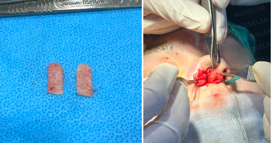 Medpor removal from the nasal tip – extracted Medpor pieces on surgical table and intraoperative photo showing removal from the nasal tip