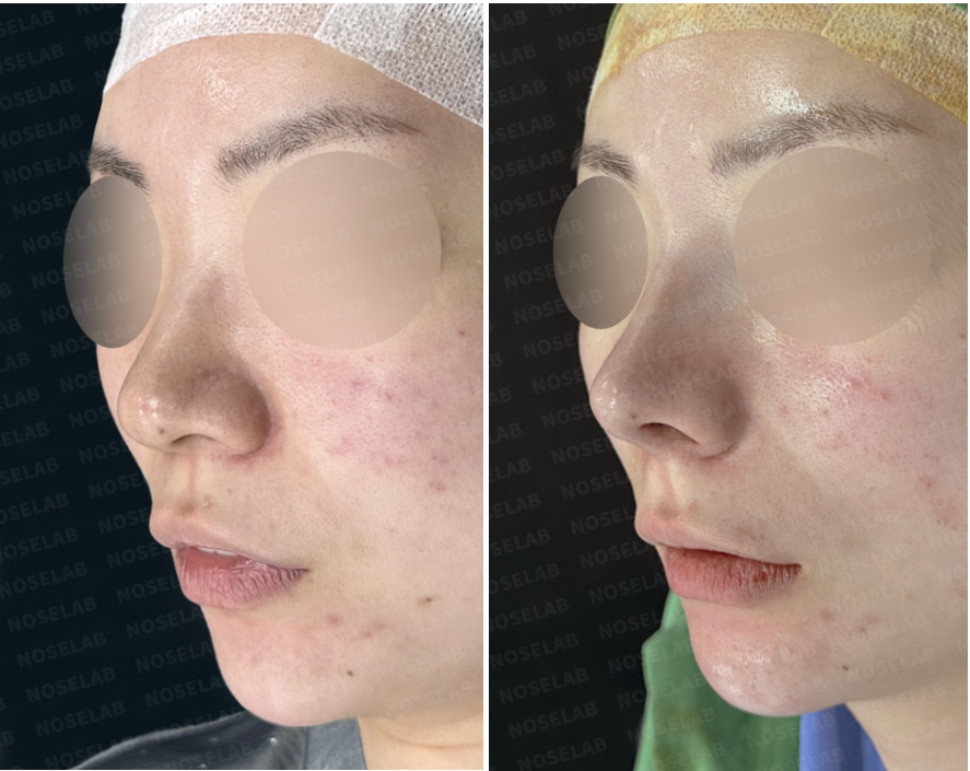 Oblique view before and immediately after Bulbous Tip Rhinoplasty Korea showing refined nasal tip.