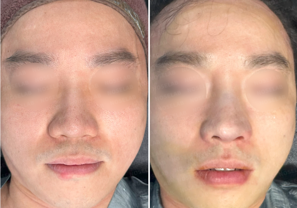 Frontal view before and after male bulbous nose correction through Closed Rhinoplasty Korea, showing improved nasal tip definition and nostril symmetry.