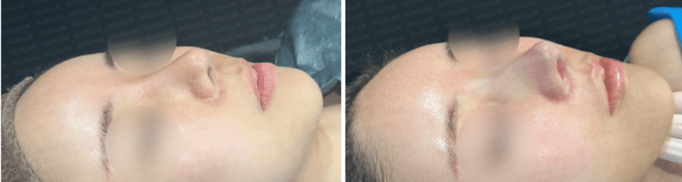 45-degree angle view before surgery (left) after surgery (right)