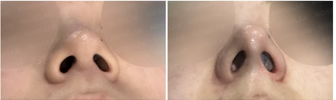 Before and immediately after surgery nostril view showing restoration of the previously retracted columella and improved nostril symmetry following revision closed rhinoplasty with autologous rib cartilage reconstruction.