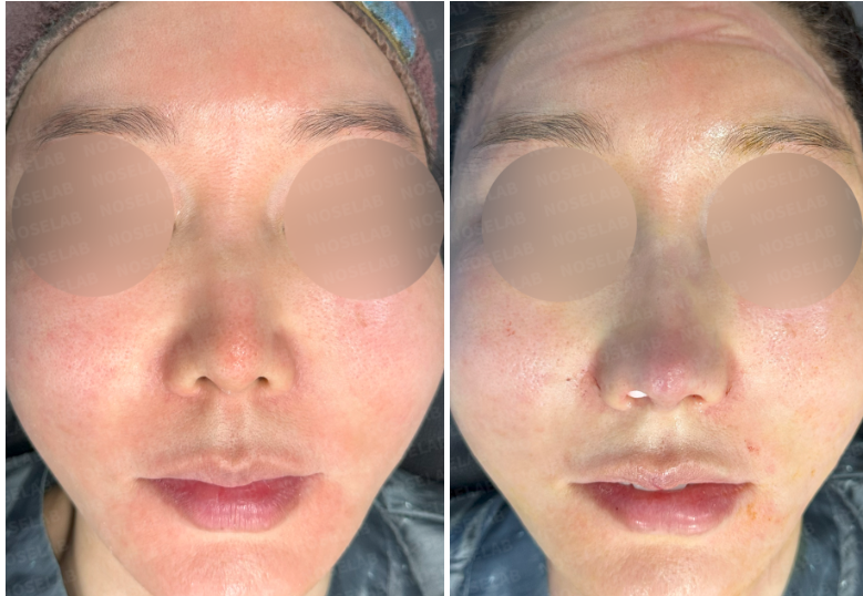 Frontal view before revision rhinoplasty (left) and immediately after surgery (right) – showing improved nostril symmetry and nasal tip projection.