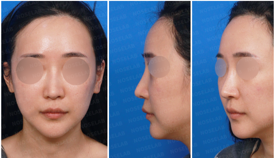Preoperative consultation photos before structural reconstruction rhinoplasty – frontal, left oblique, and side views showing nasal asymmetry and tip position before surgery.