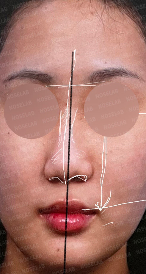 Preoperative frontal photo showing facial asymmetry and nasal deviation before Deviated and Small Nose Correction – Closed Rhinoplasty Korea.