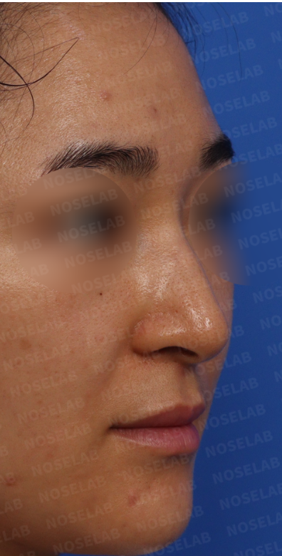 Nose hump correction Korea – preoperative 45-degree view showing long hooked nose and high nasal bridge