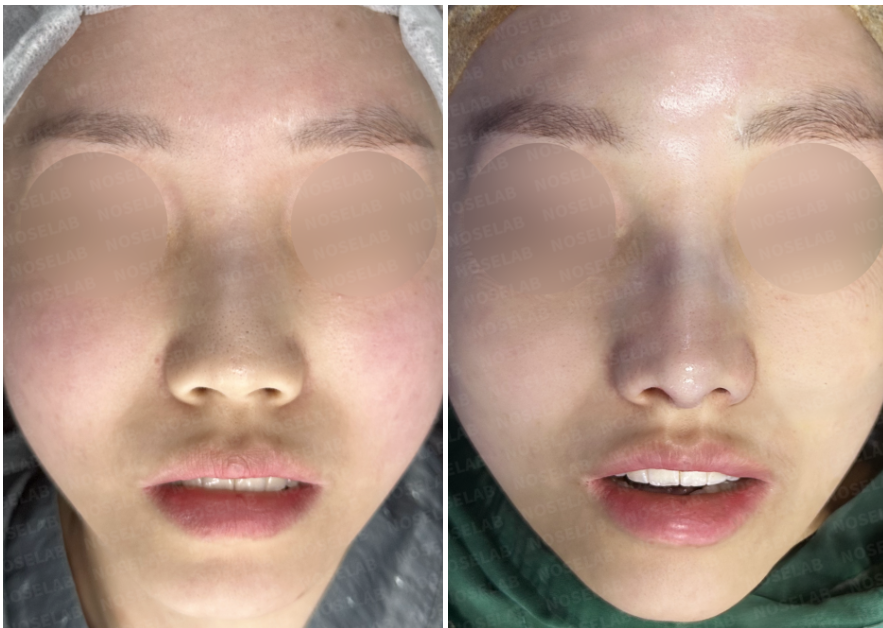 Before and immediately after surgery frontal view showing correction of a crooked nasal bridge and elevation of the drooping nasal tip using implant-free closed rhinoplasty with rib cartilage.