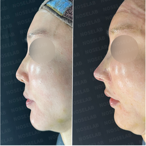 Before and after photos of revision rhinoplasty for dorsal hump and nostril exposure correction.