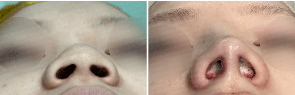Nostril before-and-after photos showing narrower nasal base, improved nostril symmetry, and more balanced alar-columella relationship.