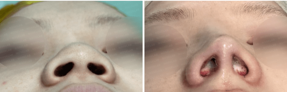 Nostril before-and-after photos showing narrower nasal base, improved nostril symmetry, and more balanced alar-columella relationship.