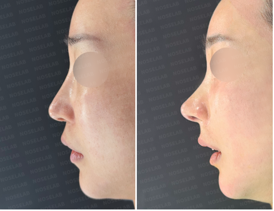 Before and immediately after structural reconstruction rhinoplasty – side view showing enhanced nasal bridge, improved columella alignment, and balanced facial profile.
