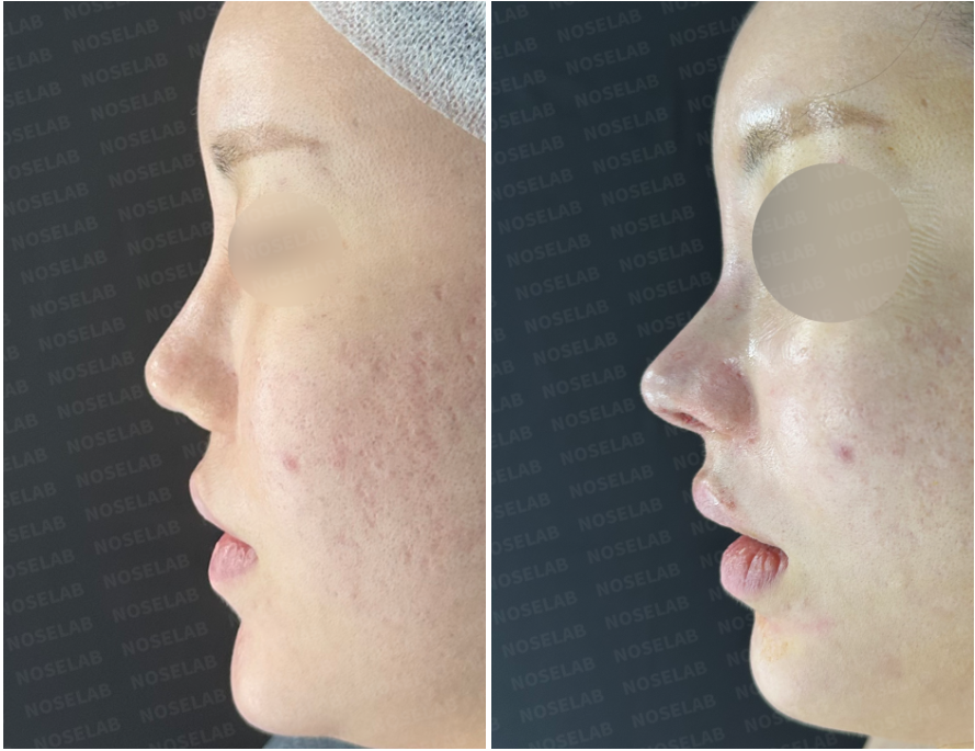 Side profile comparison before (left) and immediately after (right) revision rhinoplasty using autologous rib cartilage.