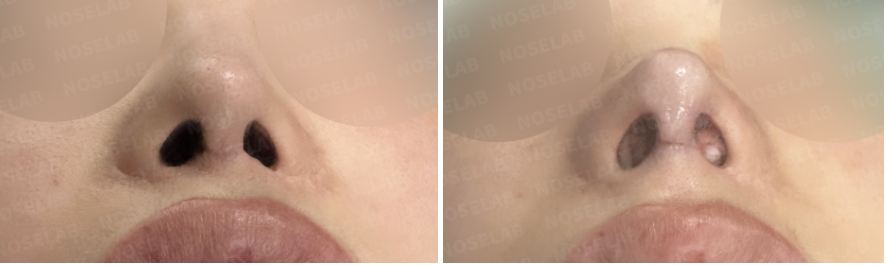 Nostril base view before and after Defined Nasal Tip Rhinoplasty showing improved symmetry.