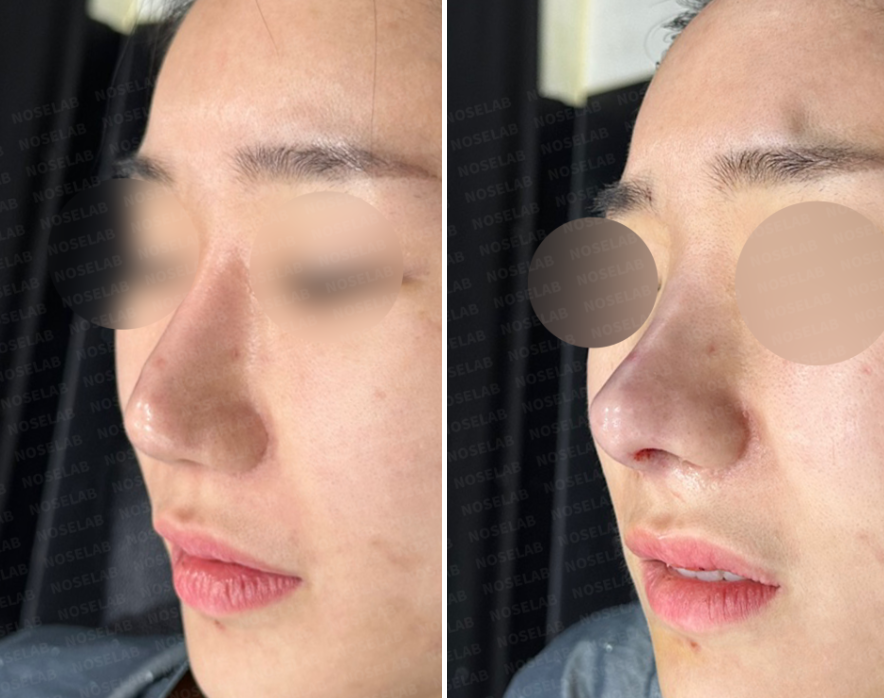 Before and immediately after 45-degree oblique view of nostril reconstruction following excessive nostril reduction with rib cartilage graft and closed rhinoplasty