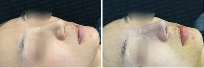 Before surgery (left), after surgery (right)