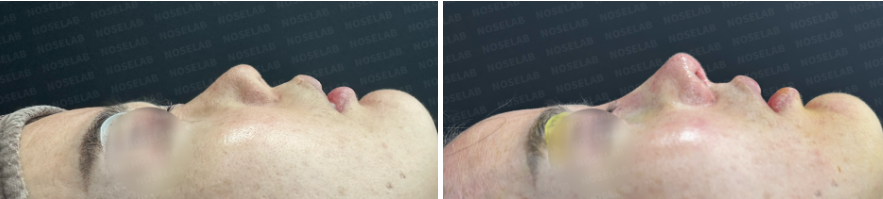 Short nose and columellar depression correction – side profile view before surgery (left) and after revision rhinoplasty (right)