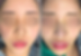 Frontal view comparison of the patient's nose before (left) and immediately after (right) revision rhinoplasty, showing improved nasal shape and tip projection.