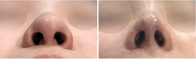 Nostril view comparison before and after closed rhinoplasty Korea: Improved nostril symmetry and refined nasal tip support.