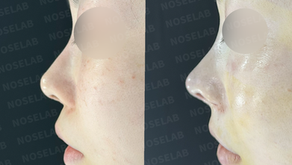 Before and after photos of septal cartilage overharvest correction through closed rhinoplasty in Korea