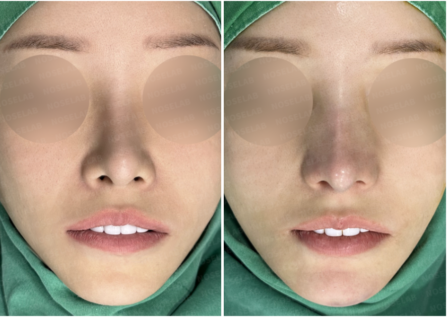 Before and after short nose correction — frontal view showing improved nasal length, reduced nostril exposure, and balanced facial proportion.