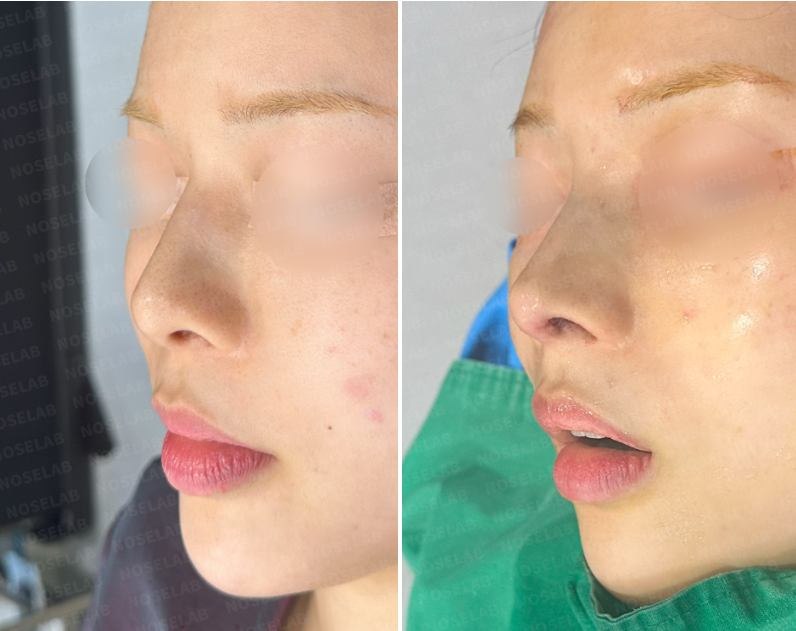 Before and after nostril asymmetry correction surgery: oblique side view comparison