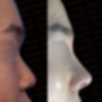 Small and Short Nose Rhinoplasty Korea before and after side view – showing improved nasal length and natural projection after closed rhinoplasty by Dr. Cha-Young Kang