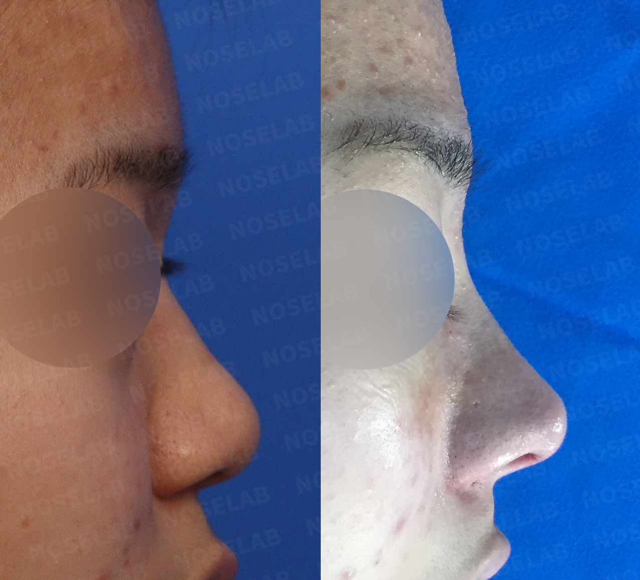 Comparative profile images demonstrating nasal projection enhancement and tip definition improvement